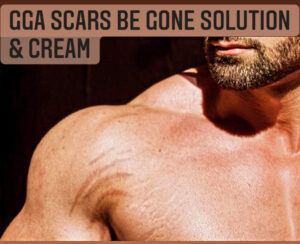 GGA Scar Be Gone Solution with GGA Alonut Cream